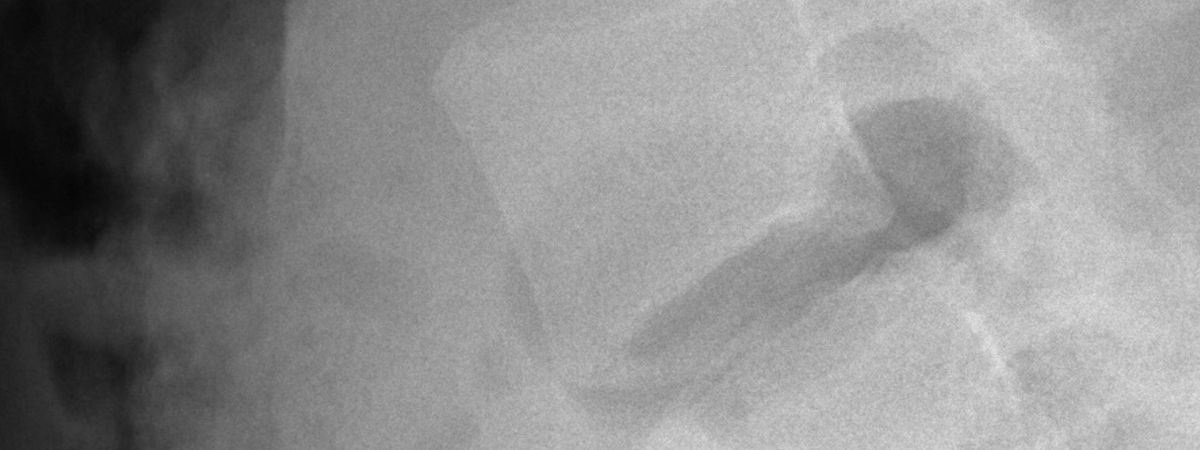 Columna vertebralis